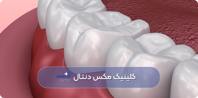 پر كردن دندان با ليزر