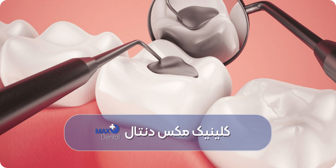 عوارض و مشکلات احتمالی بعد از پر کردن دندان و راه های مقابله با آن ها