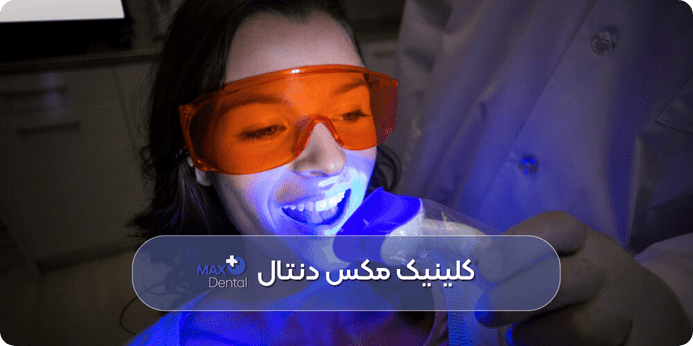 ماندگاری بلیچینگ دندان چقدر است