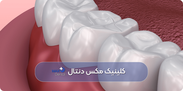 پر كردن دندان با ليزر