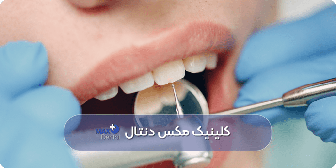 انواع روش های تخصصی جرم گیری