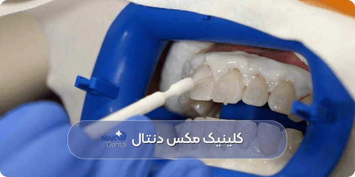 چرا بعضی افراد نیاز به چند جلسه بلیچینگ دارند