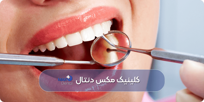 قیمت جرمگیری دندان ۱۴۰۴ چقدر تقریبا می شود