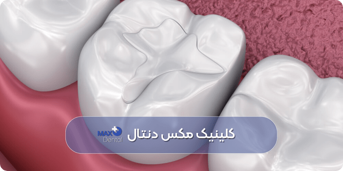 آیا میتوان دندان پر شده را سفید (بلیچینگ) کرد