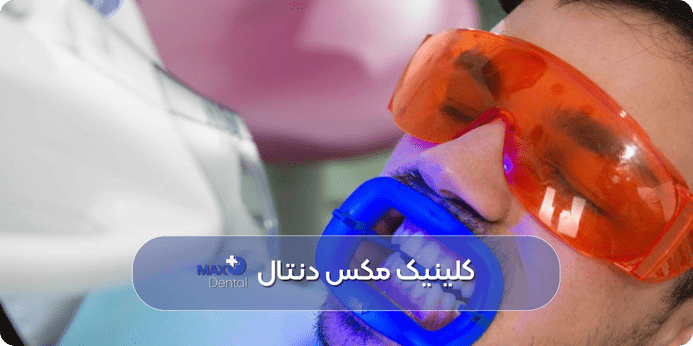 بلیچینگ دندان چقدر زمان می برد