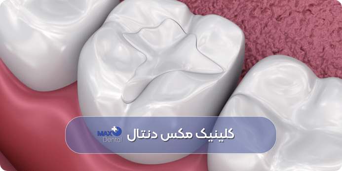 آیا میتوان دندان پر شده را سفید (بلیچینگ) کرد
