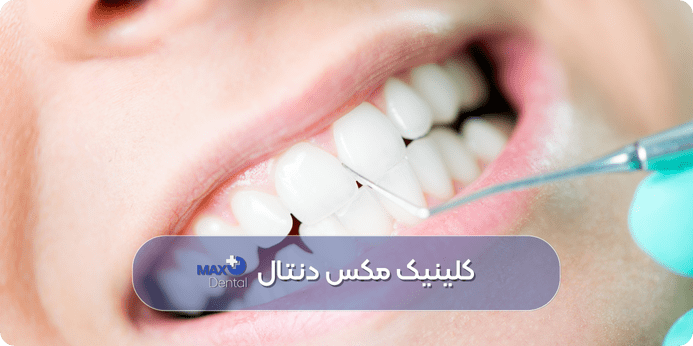 آیا جرم گیری دندان های لمینت و کامپوزیت شده ممکن است