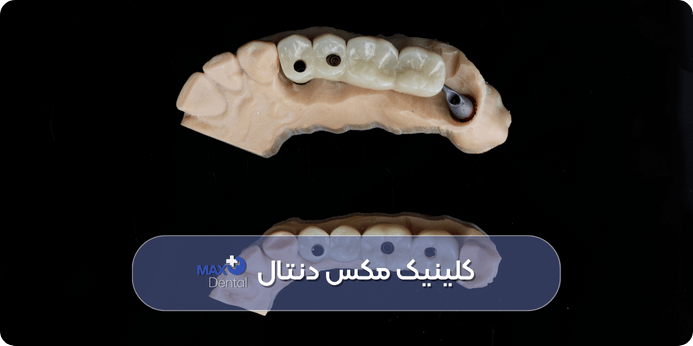 فیلم ترمیم دندان با بریج