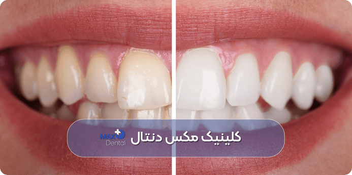 مراحل روش های بلیچینگ دندان در مطب