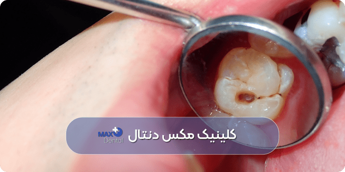 پرکردن دندان چیست و چه زمانی باید انجام شود
