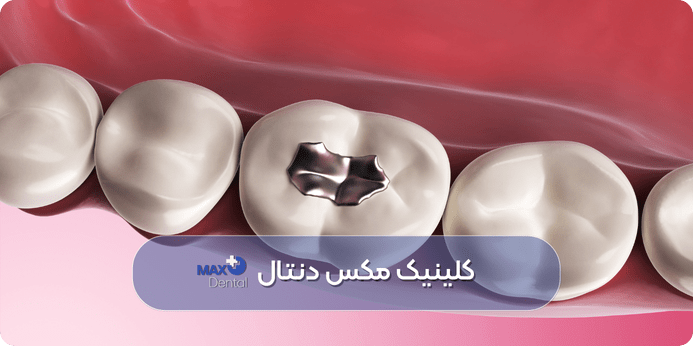 فیلم ترمیم دندان با پرکردن