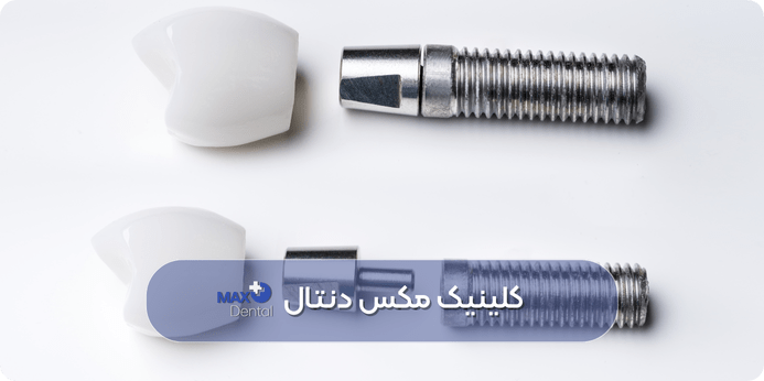 مزایای ایمپلنت دندان