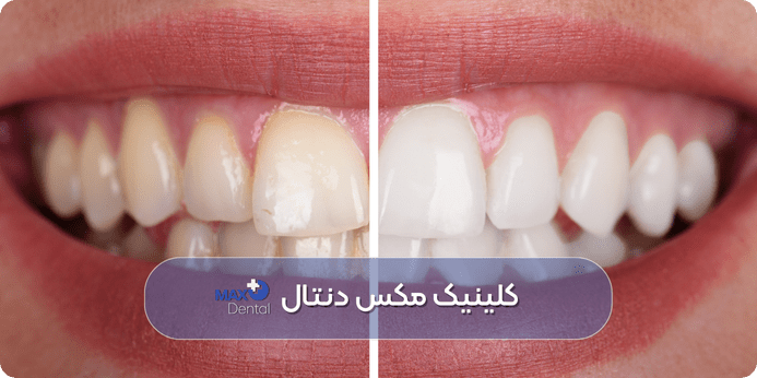 آیا واقعا روش های خانگی برای سفید کردن دندان موثر و بی خطر هستند
