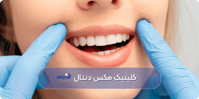 سفید کردن دندان در دندانپزشکی بهتر است یا خانه