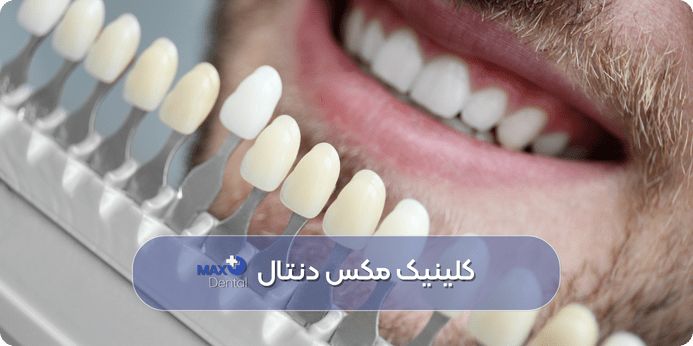 انواع ونیرهای دندانی