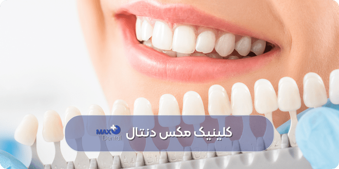 چه کسانی بهترین کاندید برای سفيد كردن دندان ها در دندانپزشکی هستند