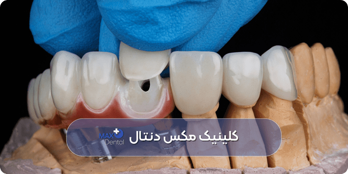 طول عمر ونیر دندان چقدر است