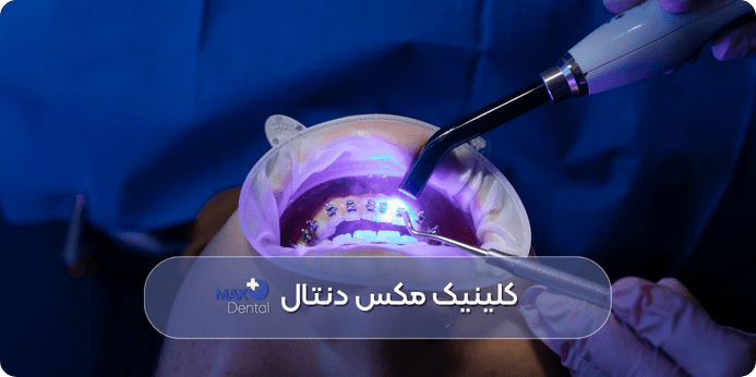 بهترین روش های سفید کردن دندان در دندانپزشکی