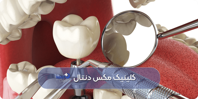عوارض ایمپلنت چیست