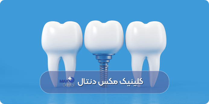 ایمپلنت دندان برای چه کسانی مناسب نیست