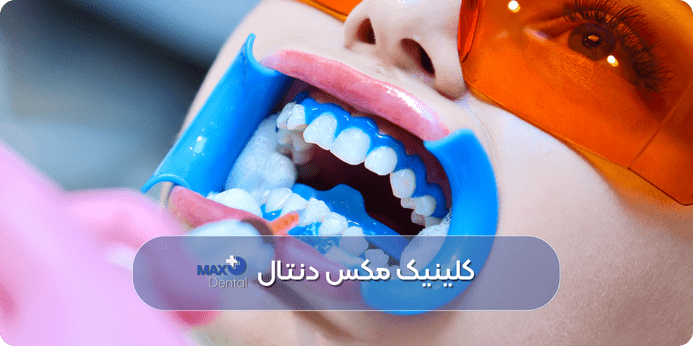 مراقبت های کلیدی برای افزایش و حفظ ماندگاری سفیدی دندان ها