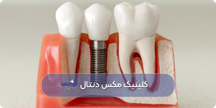 قیمت ایمپلنت دندان در 1404