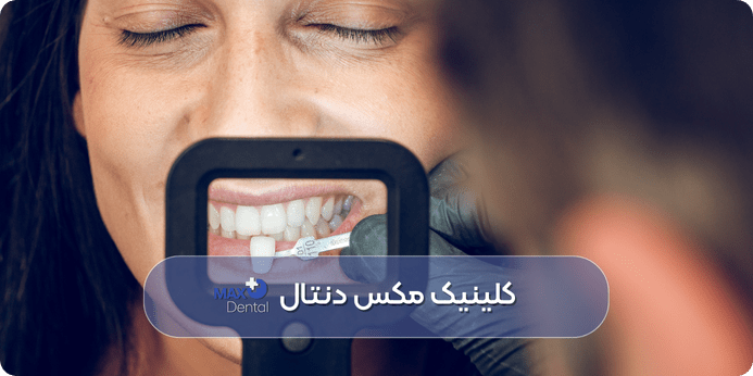 جایگزین های درمانی ونیر