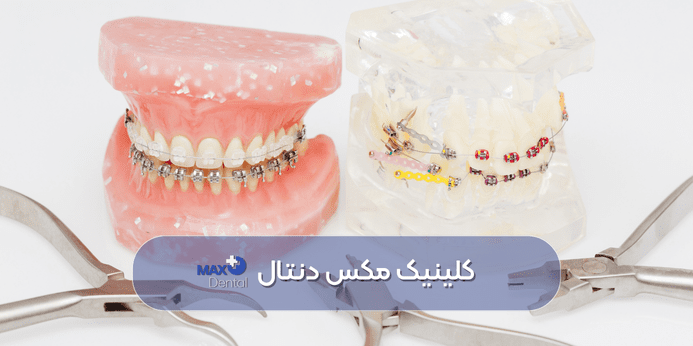 مهمترین فاکتورهای موثر در تعیین سن ارتودنسی دندان