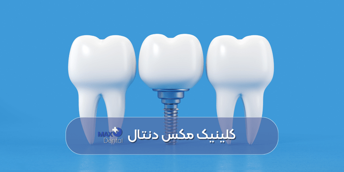 علت درد بعد از ایمپلنت دندان پس از گذشت یک سال چیست