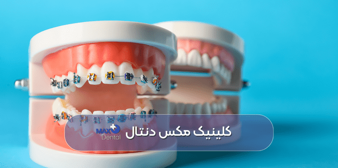 تاثیر طول درمان به سن ارتودنسی دندان