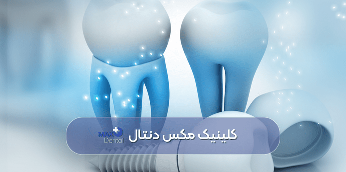 میزان درد بعد از ایمپلنت دندان چگونه است