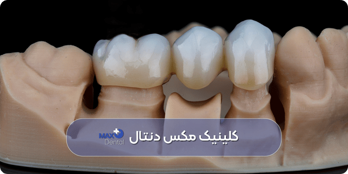 بریج دندان یا پل دندانی، یکی از بهترین راههای جایگزین دندان کشیده شده