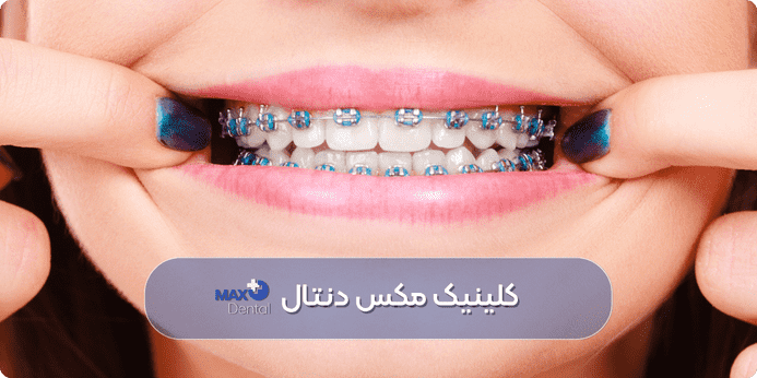 رنگ ارتودنسی دخترانه آبی