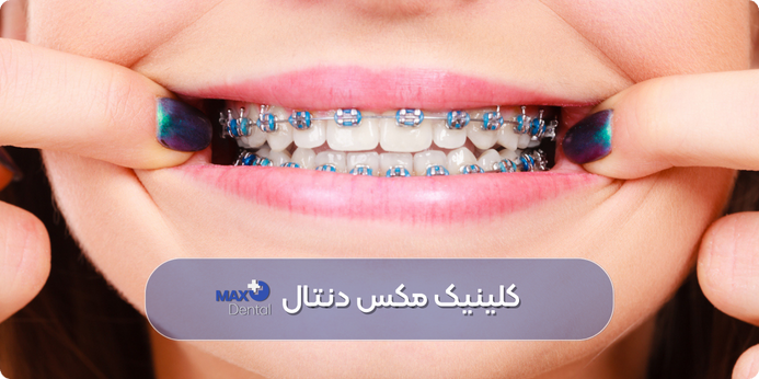 رنگ ارتودنسی آبی