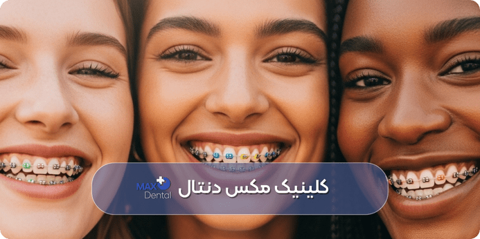 نکات مهم در انتخاب بهترین رنگ ارتودنسی دخترانه