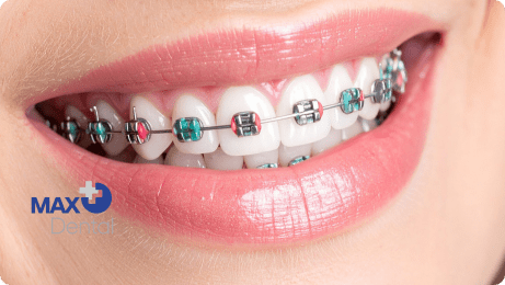 بهترین رنگ ارتودنسی دخترانه کدام است؟