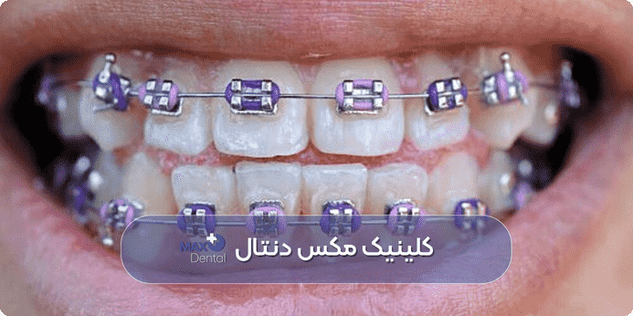 رنگ ارتودنسی دخترانه بنفش