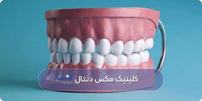 دندان مصنوعی متحرک برای جایگزین دندانهای کشیده شده