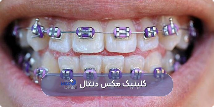 رنگ ارتودنسی بفنش