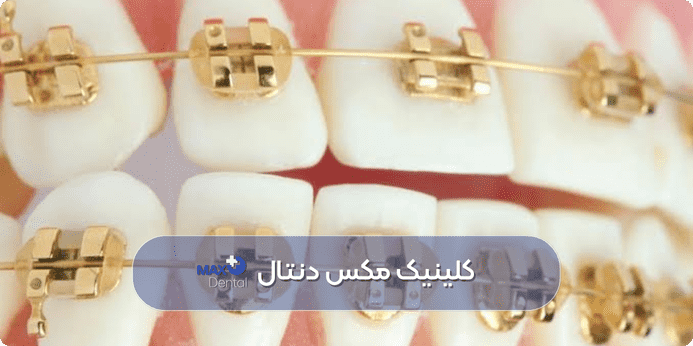 رنگ ارتودنسی مخصوص دختران، طلایی