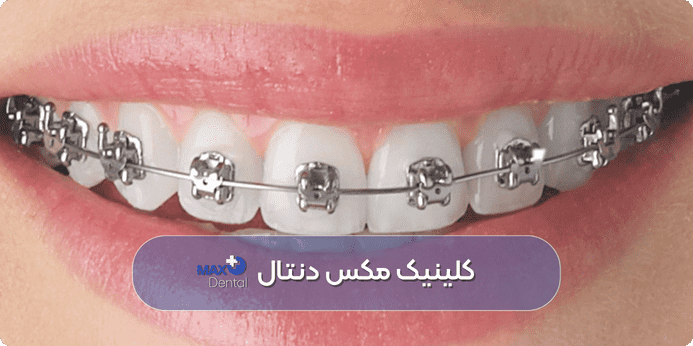 طوسی یکی از بهترین رنگ های ارتودنسی دخترانه