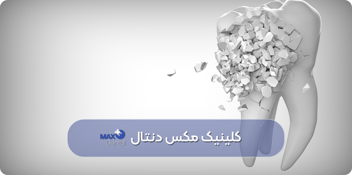 در صورت عدم جایگزینی دندان کشیده شده، چه میشود