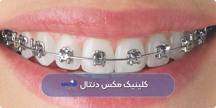 رنگ ارتودنسی طوسی