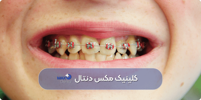 رنگ نگین ارتودنسی دخترانه قرمز