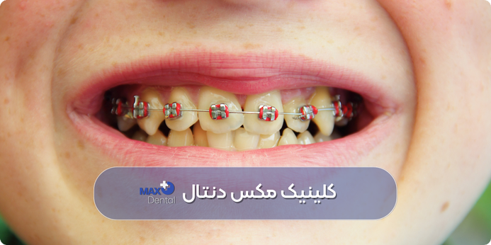 رنگ ارتودنسی قرمز