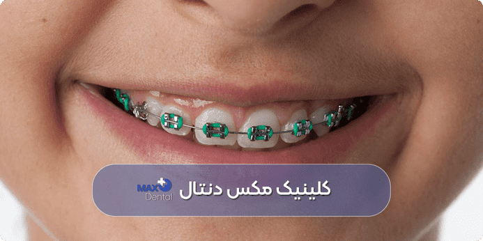 رنگ براکت ارتودنسی دخترانه سبز