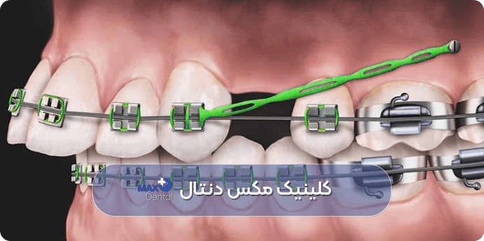 آیا ارتودنسی برای جایگزینی دندان کشیده شده مناسب است