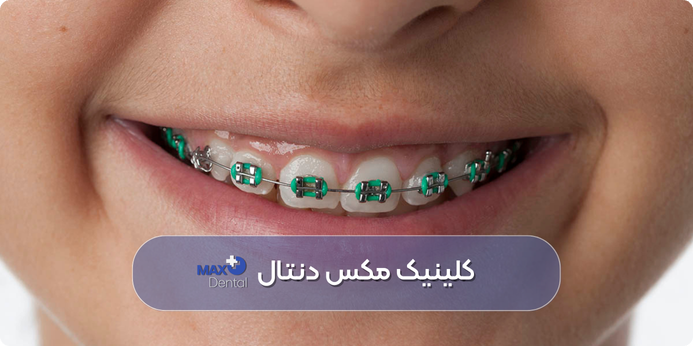 رنگ ارتودنسی سبز