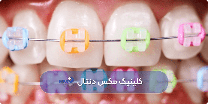 رنگ ارتودنسی رنگین کمانی