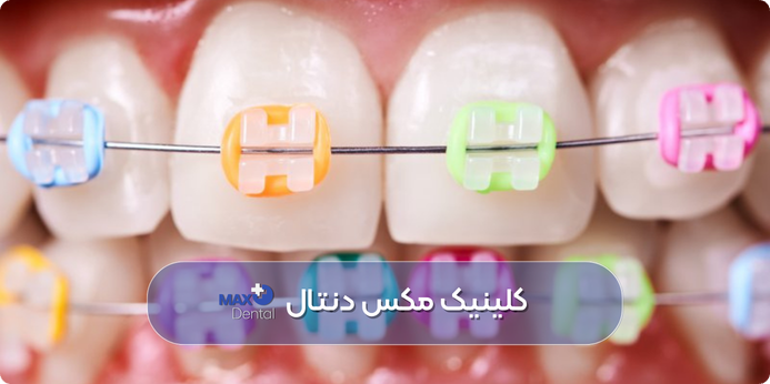 رنگ ارتودنسی رنگین کمانی